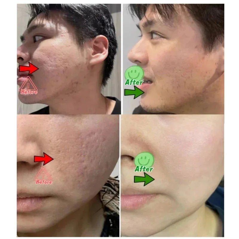 Acne Scar Repair Cream for Pores, Blackheads, and Skin Smoothing